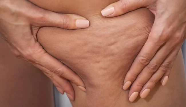 17694-cellulite-607252182