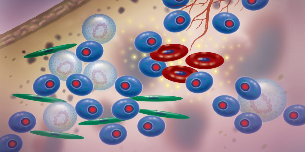 Multiple myeloma cells illustration