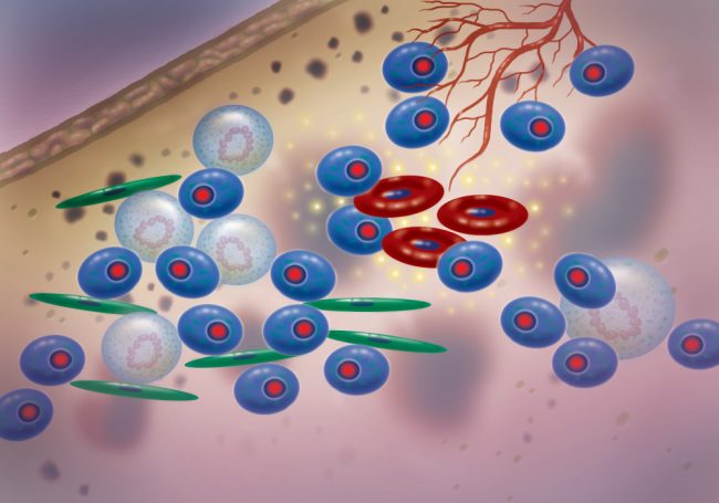Multiple myeloma cells illustration