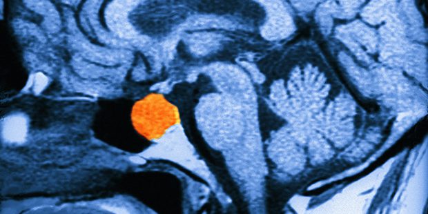 M1340454-Brain_tumour-SPL-20170215030850404