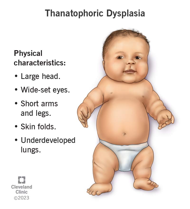 دیسپلازی تاناتوفوریک (Thanatophoric dysplasia) چیست ؟