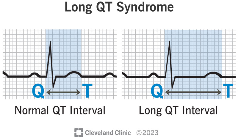 سندرم کیوتی طولانی (Long QT Syndrome یا LQTS)