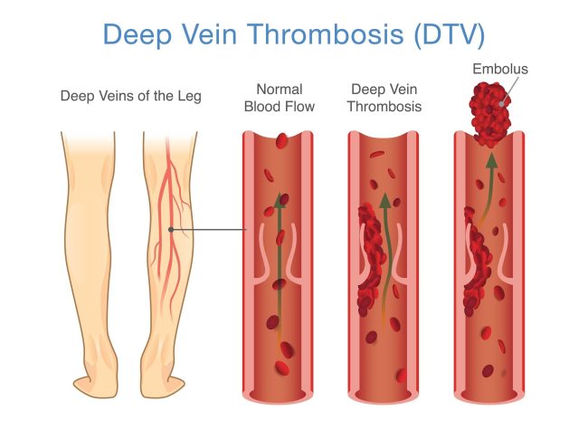 Medical Diagram of Deep Vein Thrombosis at leg area. Illustratio