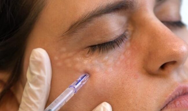 تزریق اگزوزوم تیرگی دور چشم