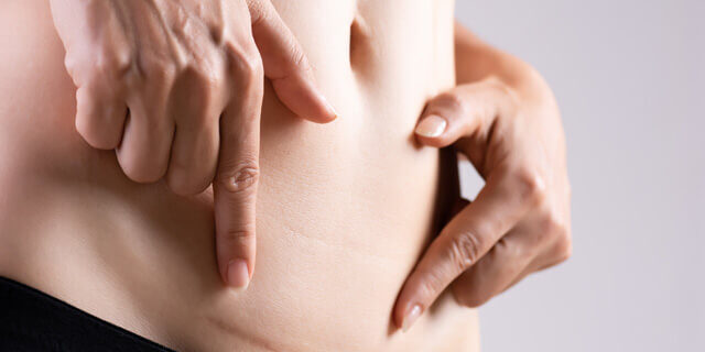 Scar-and-Stretch-Marks-Treatments-ExoScar