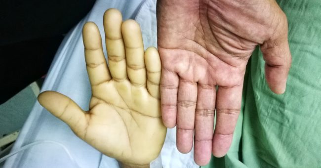 Aplastic-Anemia-1200