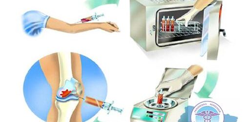 ortokin-terapiya-sustavov