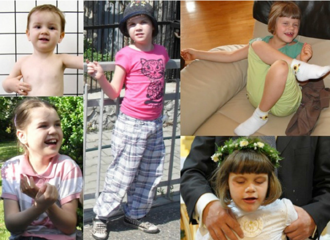 Photos-of-patients-with-type-II-adenylosuccinate-lyase-deficiency