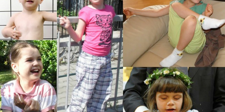 Photos-of-patients-with-type-II-adenylosuccinate-lyase-deficiency