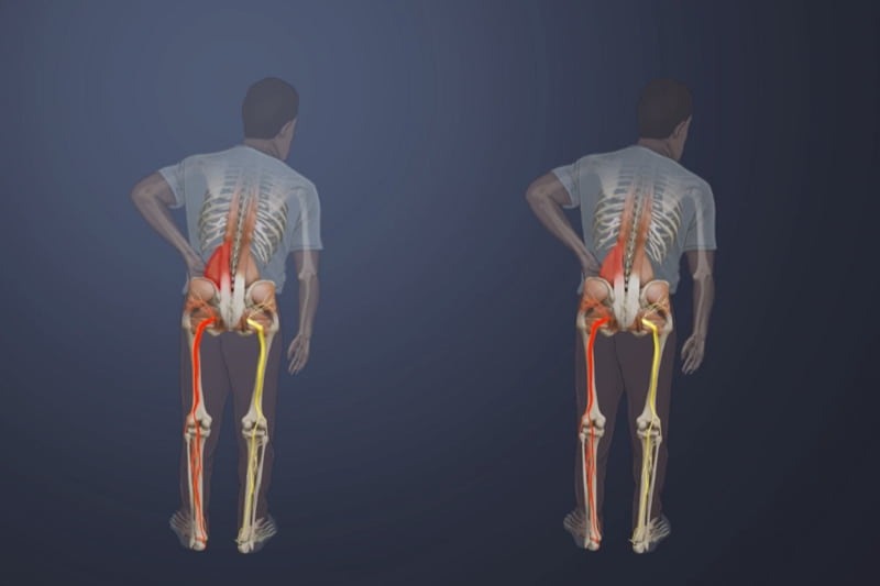 آیا باید برای کمردرد از یخ استفاده کنم یا گرما؟